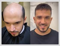 Resultado de prótese capilar em Goiânia, cliente antes e depois