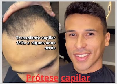 Prótese capilar aplicada em Goiânia, comparação com transplante anterior